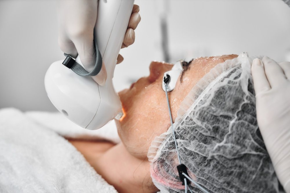 Điều trị mụn trứng cá bằng ánh sáng IPL