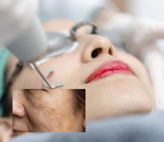 Điều trị rám má & tăng sắc tố bằng laser toning